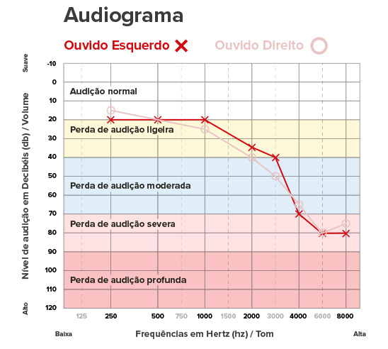 Audiograma mostrando níveis de perda auditiva no ouvido esquerdo em diferentes frequências, indicando perda de audição de leve a profunda.