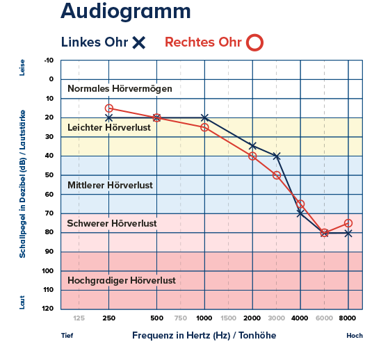 Ein Audiogramm zeigt den Hörverlust für das linke Ohr (X) und das rechte Ohr (O); die Kurven illustrieren abnehmendes Hörvermögen von leichtem bis hochgradigem Hörverlust über Frequenzen (125–8000 Hz).