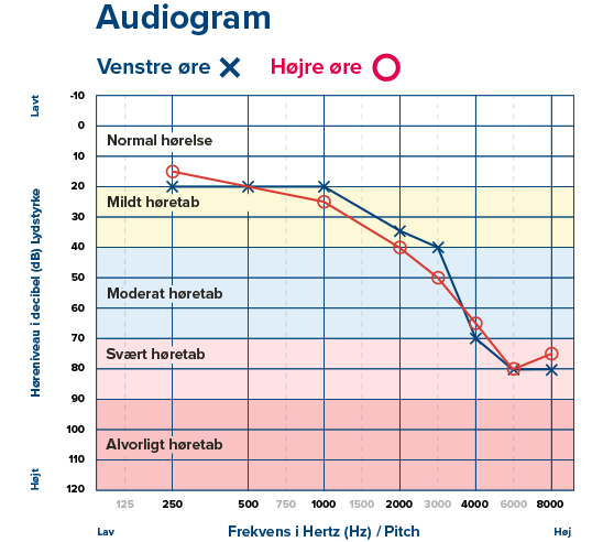 Audiogram med resultater for venstre øre (X) og højre øre (O), der viser høretab fra mildt til alvorligt ved forskellige frekvenser (125-8000 Hz). Tekst: 'Normal hørelse, Mildt høretab, Moderat høretab, Svært høretab, Alvorligt høretab.'