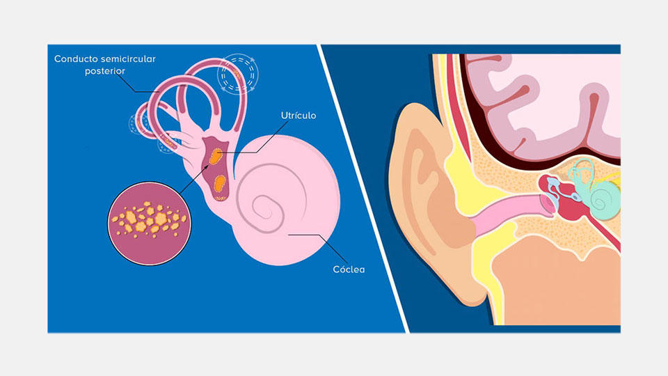 Ilustración anatómica del oído interno resaltando el conducto semicircular posterior, el utrículo y la cóclea. Incluye un recuadro detallado de otolitos y contexto educativo sobre la función auditiva.