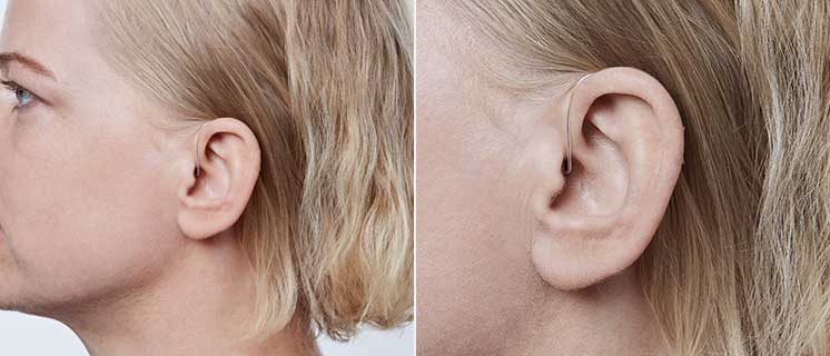 Un audífono discreto detrás de la oreja derecha de una persona rubia. El dispositivo, posiblemente de Audika, se ajusta cómodamente; fondo blanco, típico de imágenes promocionales de clínicas auditivas.