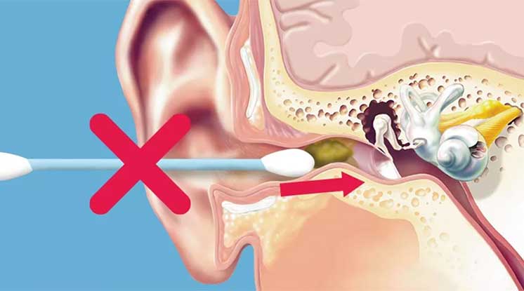 Un hisopo con una cruz roja se muestra empujando cerumen hacia el interior del canal auditivo. Fondo ilustrado con el oído interno, promoviendo el cuidado auditivo y prevención.
