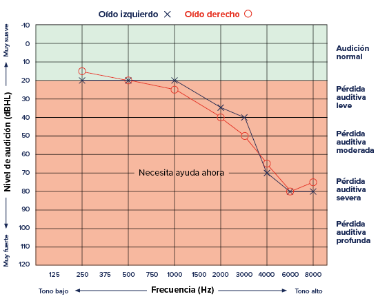Un audiograma que muestra pérdida auditiva