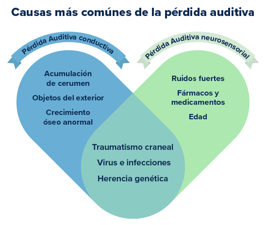 Un diagrama en forma de dos círculos superpuestos describe las causas comunes de la pérdida auditiva. **Texto incluido:** ’Causas más comunes de la pérdida auditiva. Pérdida Auditiva Conductiva: Acumulación de cerumen, Objetos del exterior, Crecimiento óseo anormal. Pérdida Auditiva Neurosensorial: Ruidos fuertes, Fármacos y medicamentos, Edad. Ambas: Traumatismo craneal, Virus e infecciones, Herencia genética.’ Adecuado para uso en clínicas auditivas o consultas de audiología.