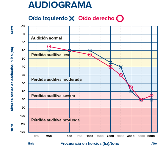 Audiograma mostrando la pérdida auditiva de ambos oídos. El oído izquierdo (X) y derecho (O) presentan una pérdida progresiva de leve a severa en frecuencias altas. Texto: ’AUDIOGRAMA’, ’Oído izquierdo X’, ’Oído derecho O’, ’Audición normal’, ’Pérdida auditiva leve’, ’Pérdida auditiva moderada’, ’Pérdida auditiva severa’, ’Pérdida auditiva profunda’, ’Nivel de sonido en decibelios/ruido (dB)’ (eje vertical), ’Frecuencia en hercios (hz)/tono’ (eje horizontal), ’Bajo’ y ’Alto’. Ideal para diagnóstico en una clínica auditiva con servicios de audiólogos.