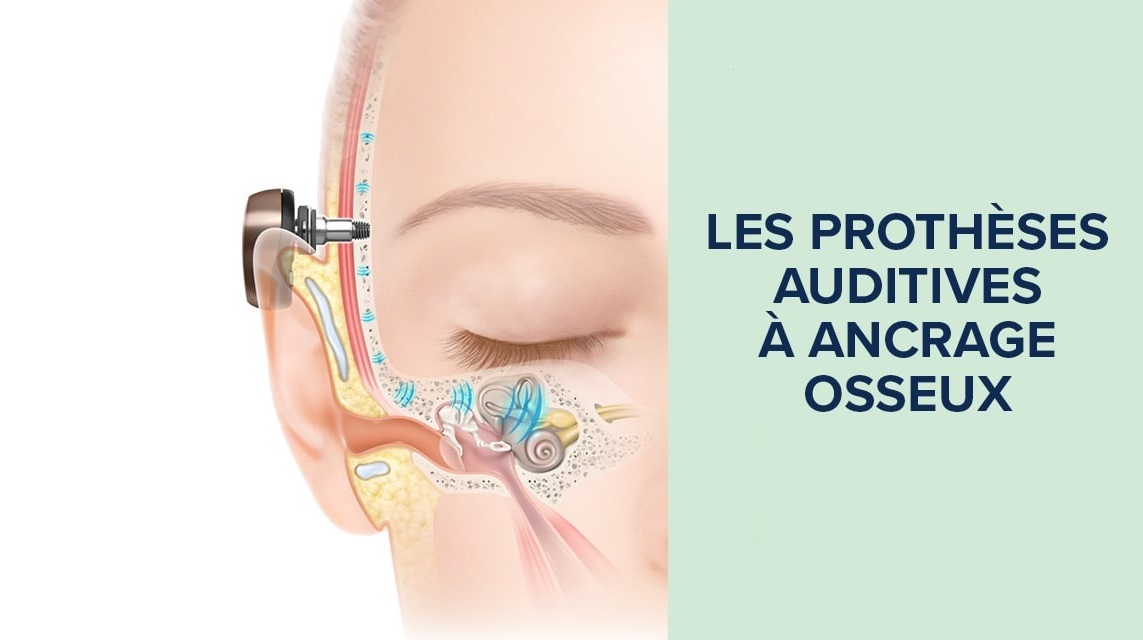 Schéma de l'oreille interne avec un implant auditif à ancrage osseux sur la partie latérale du crâne et texte 'Les prothèses auditives à ancrage osseux'.
