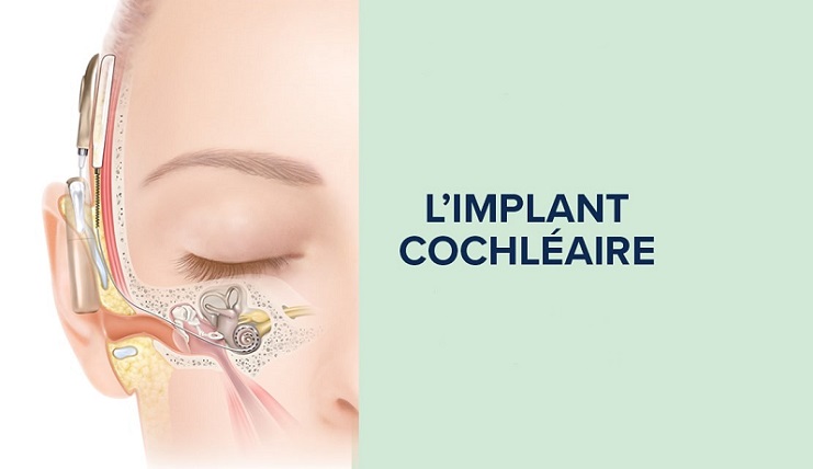 Une illustration montre un implant cochléaire fixé derrière l'oreille et connecté à l'oreille interne via des composants internes. Texte adjacent : « L’IMPLANT COCHLÉAIRE » sur fond vert clair.