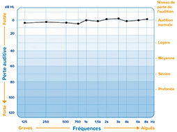 Audiogramme illustrant une audition normale avec des niveaux de pertes faibles sur toutes les fréquences.