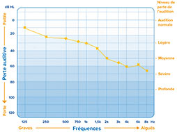Audiogramme montrant une perte auditive progressive des graves aux aigus