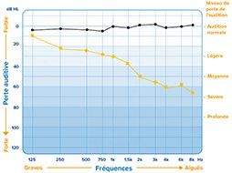 Audiogramme montrant les niveaux de perte auditive pour les deux oreilles sur différentes fréquences.