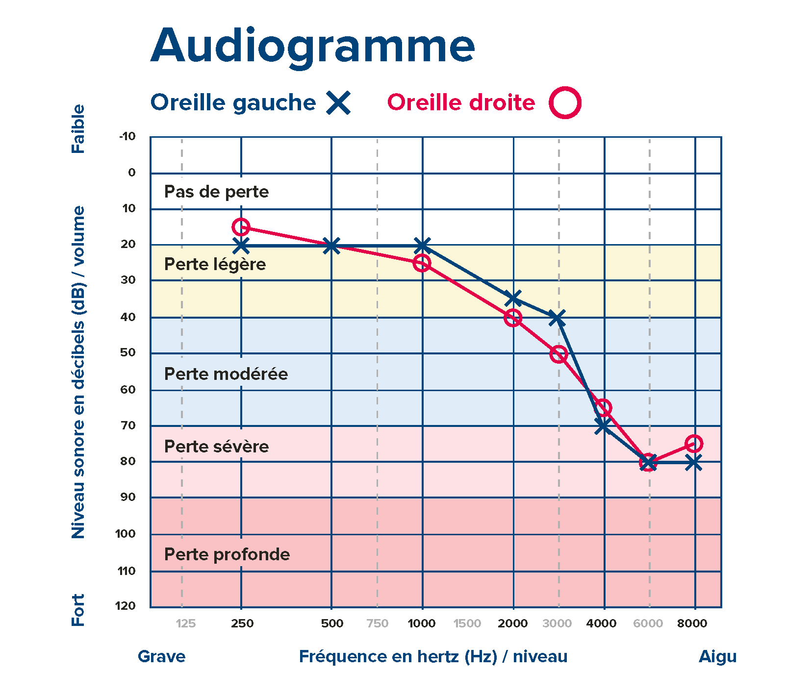Audiogramme illustrant les niveaux de perte auditive pour les oreilles gauche et droite, représentant les fréquences (Hz) et les décibels (dB) sur une échelle graduée.