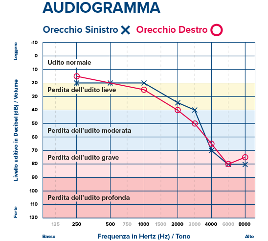 Audiogramma che mostra la soglia uditiva di un paziente.