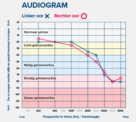 Een audiogram toont het gehoorniveau van het linker oor (X) en rechter oor (O) op verschillende frequenties (Hz). Het grafiekdiagram illustreert normaal gehoor tot zwaar gehoorverlies.