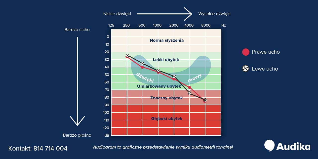 Wykres przedstawiający stopnie ubytku słuchu.