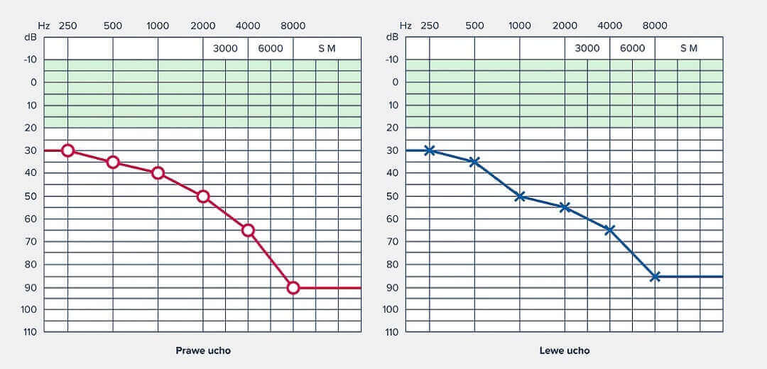 Audiometria tonalna – wyniki dla ubytku słuchu (audiogram).