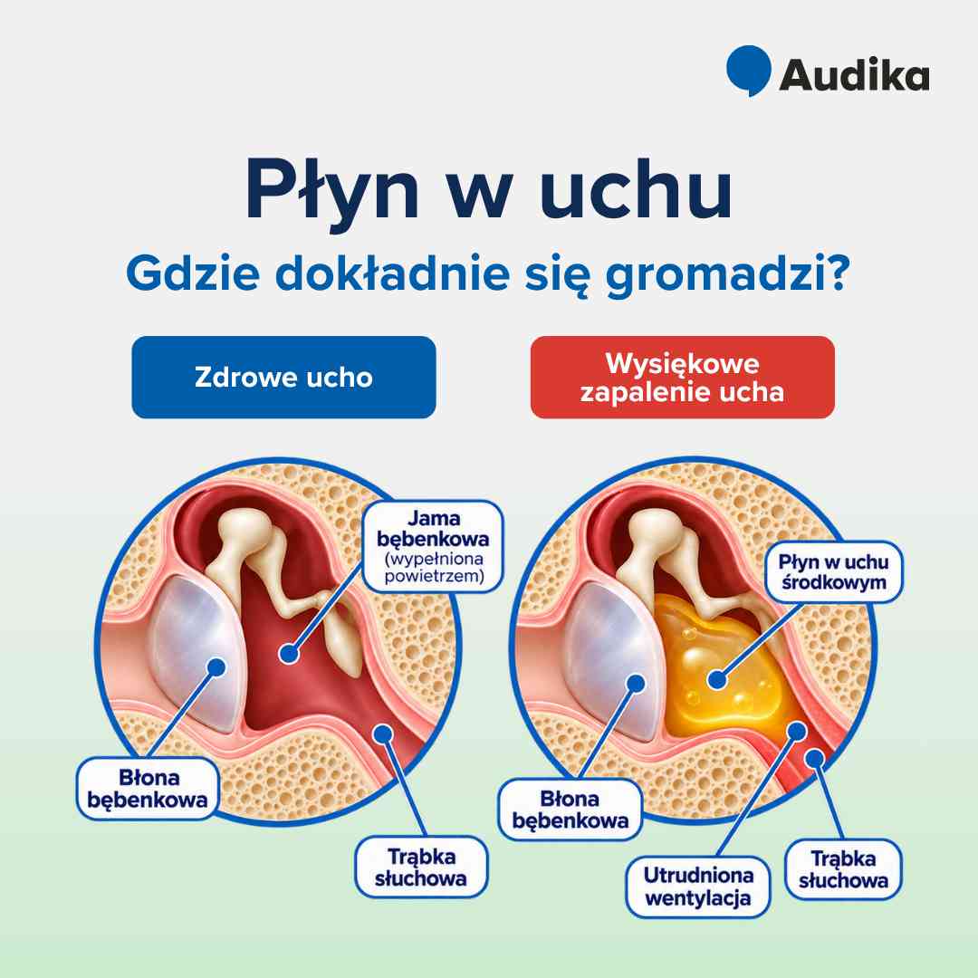 Infografika – gdzie dokładnie gromadzi się płyn w uchu?