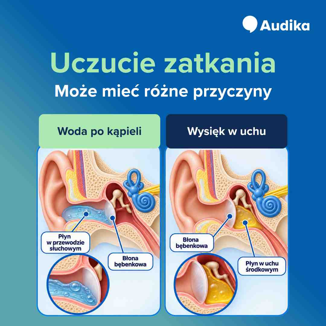 Infografika – uczucie zatkanego ucha, przyczyny