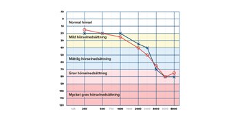  Audiogram som visar resultat av hörseltest med olika grader av hörselnedsättning.