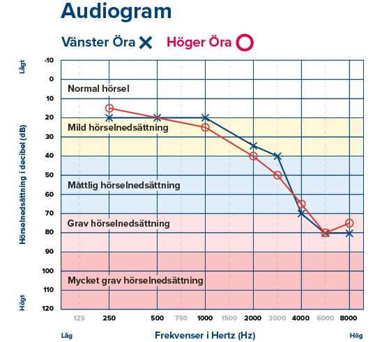  Audiogram som illustrerar hörselnivåer och olika grader av hörselnedsättning för vänster och höger öra