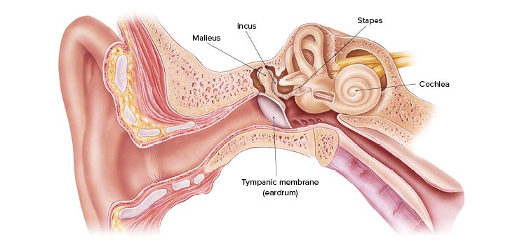 Cross-section of the human ear highlighting the middle and inner ear structures, including the tympanic membrane, malleus, incus, stapes, and cochlea, with features of otosclerosis affecting the stapes.