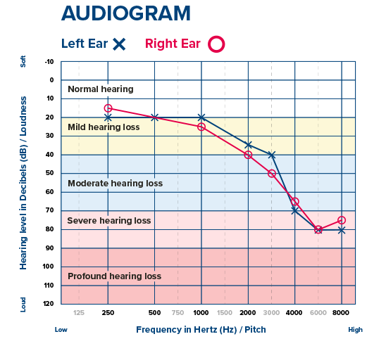 Audiogram chart showing hearing levels for left ear (blue X) and right ear (red O) across frequencies, with ranges for normal hearing, mild, moderate, severe, and profound hearing loss.
