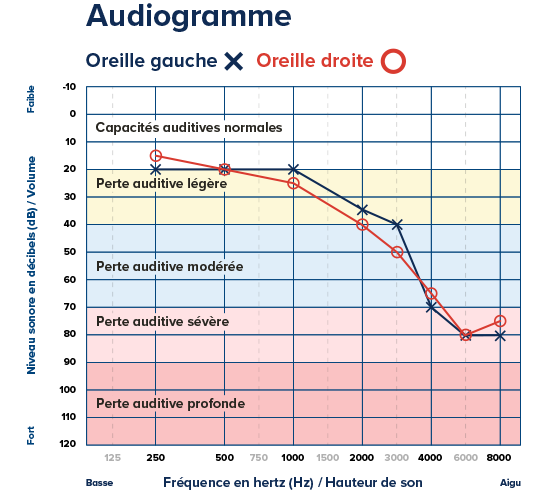Un audiogramme affiche les seuils d’audition des deux oreilles : l’oreille gauche (X) et l’oreille droite (O). Texte : « Audiogramme, Oreille gauche X, Oreille droite O ». Axes : fréquence (Hz) et niveau sonore (dB). Le graphique souligne une perte auditive légère à sévère.