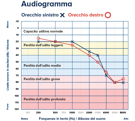 Audiogramma con dati sull’udito: simboli ’X’ per l’orecchio sinistro e ’O’ per il destro tracciano perdita uditiva su frequenze (Hz) e volume (dB), evidenziando aree da normale a profonda.