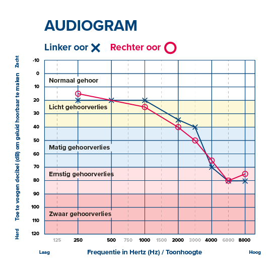 Audiogram met grafiek van linker- en rechteroor, toont niveaus van gehoorverlies van licht tot zwaar op verschillende frequenties.